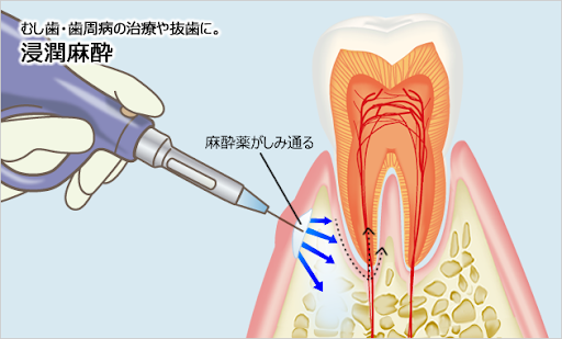 歯科麻酔