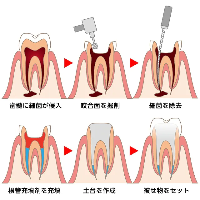 根管治療とは？